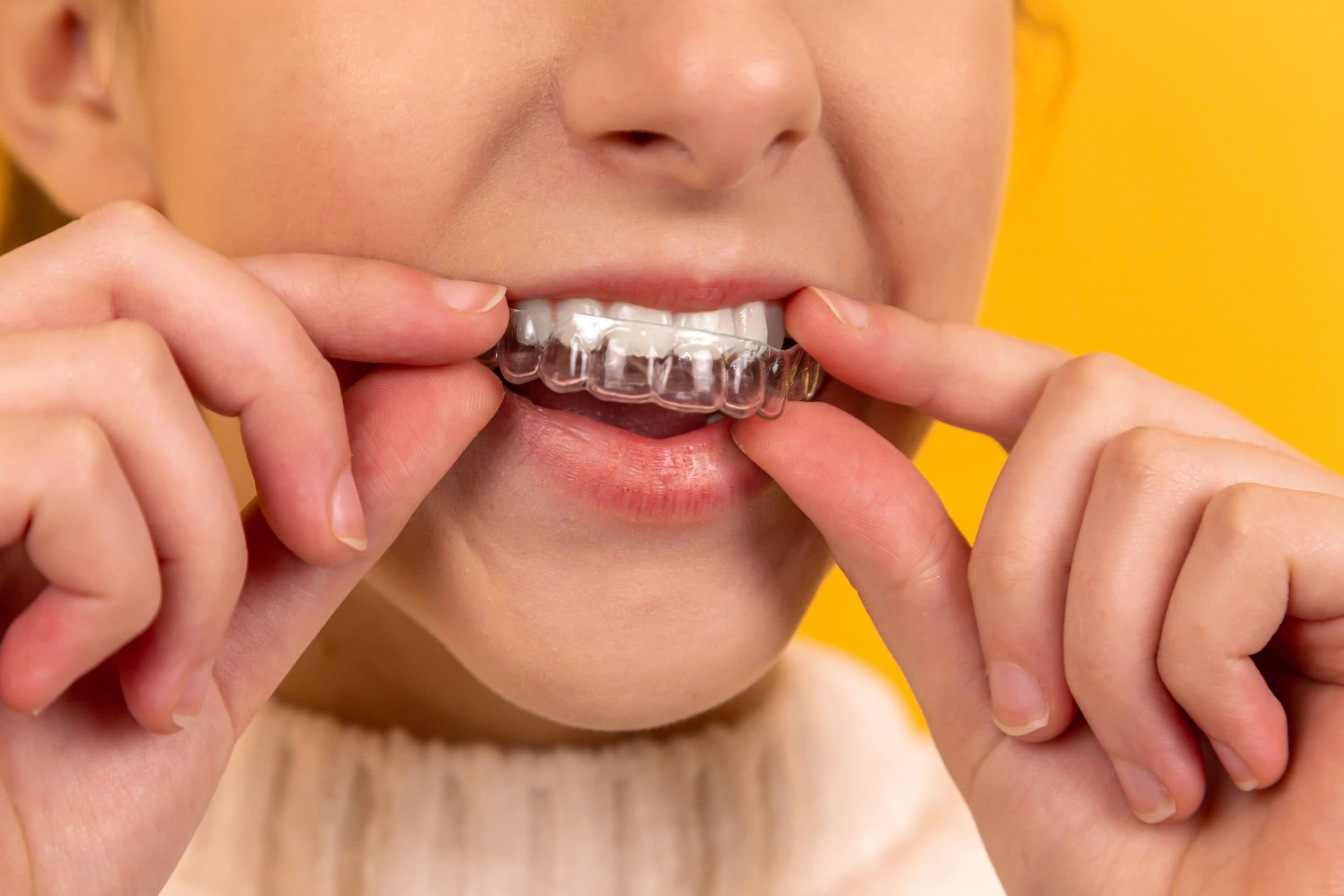 Retainers After Invisalign: Types, Costs and How Long You Need to Wear Them