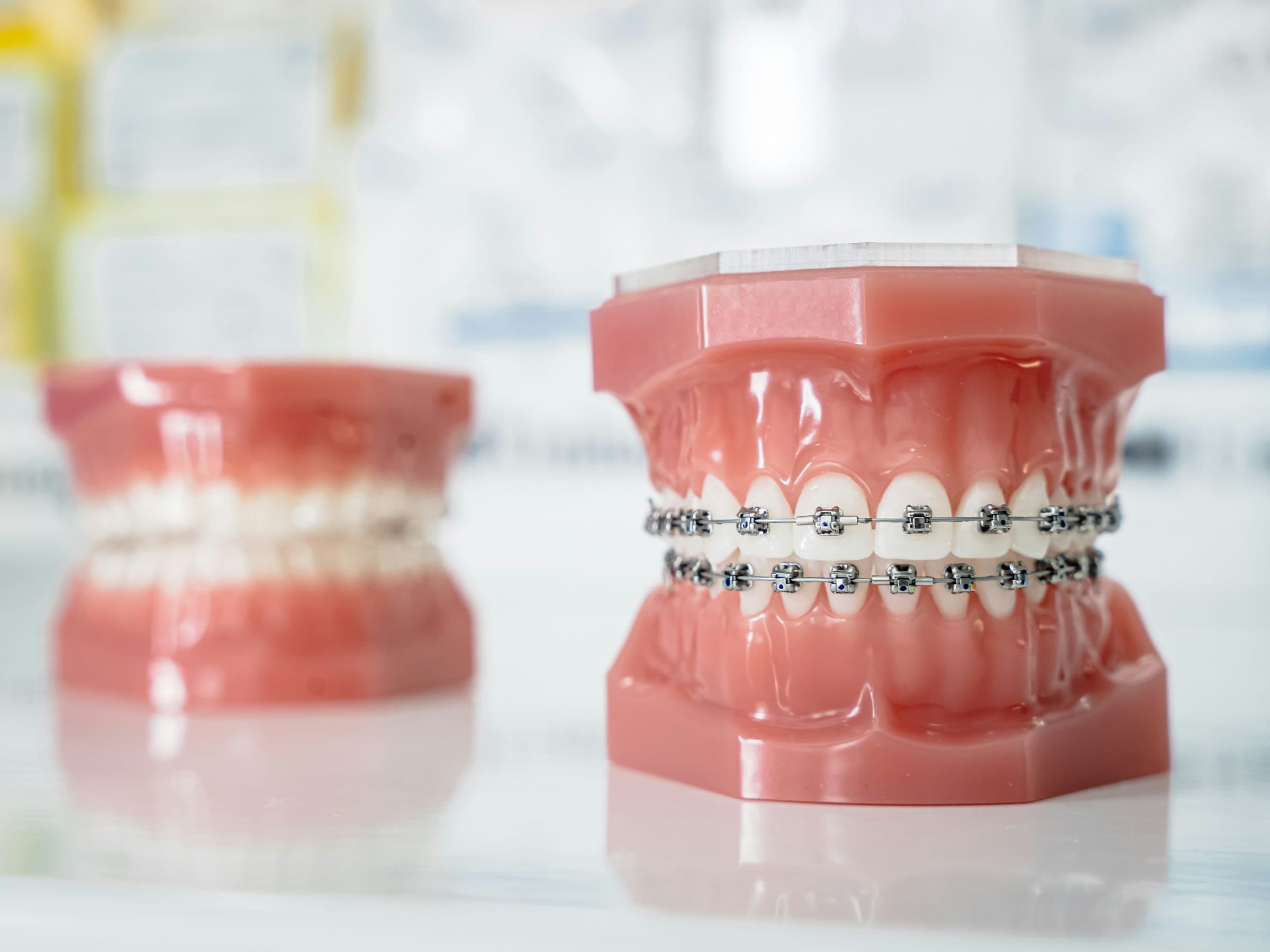 Invisalign vs Traditional Braces
